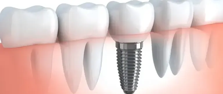 5 Things to Know Before Getting Dental Implants