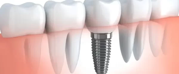 5 Things to Know Before Getting Dental Implants