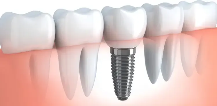 5 Things to Know Before Getting Dental Implants