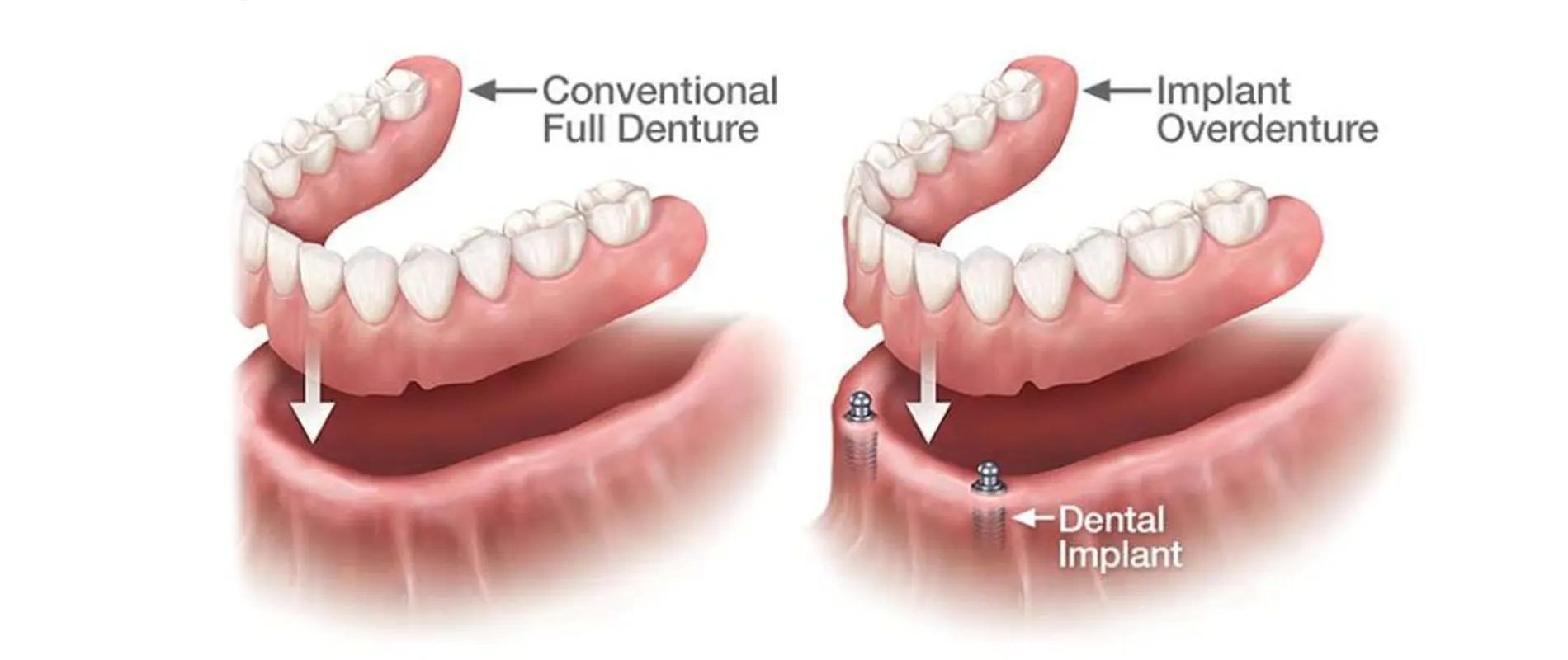 Benefits of Dental Implants Over Dentures