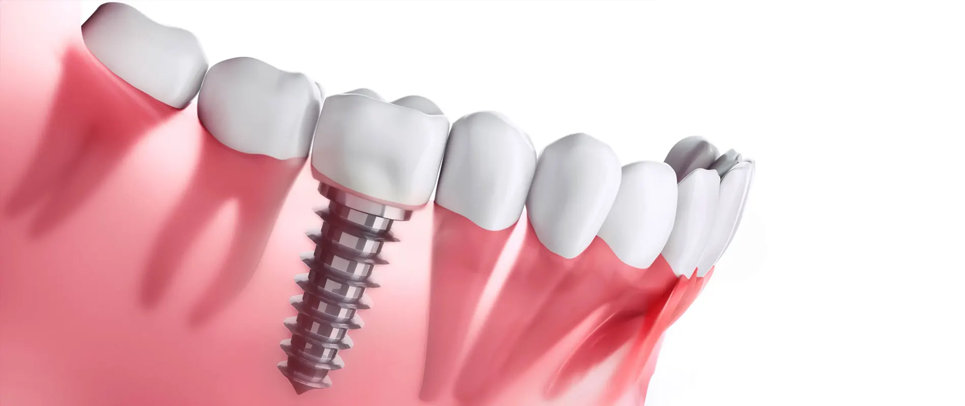 Best Private Dentist for Implants in Coventry